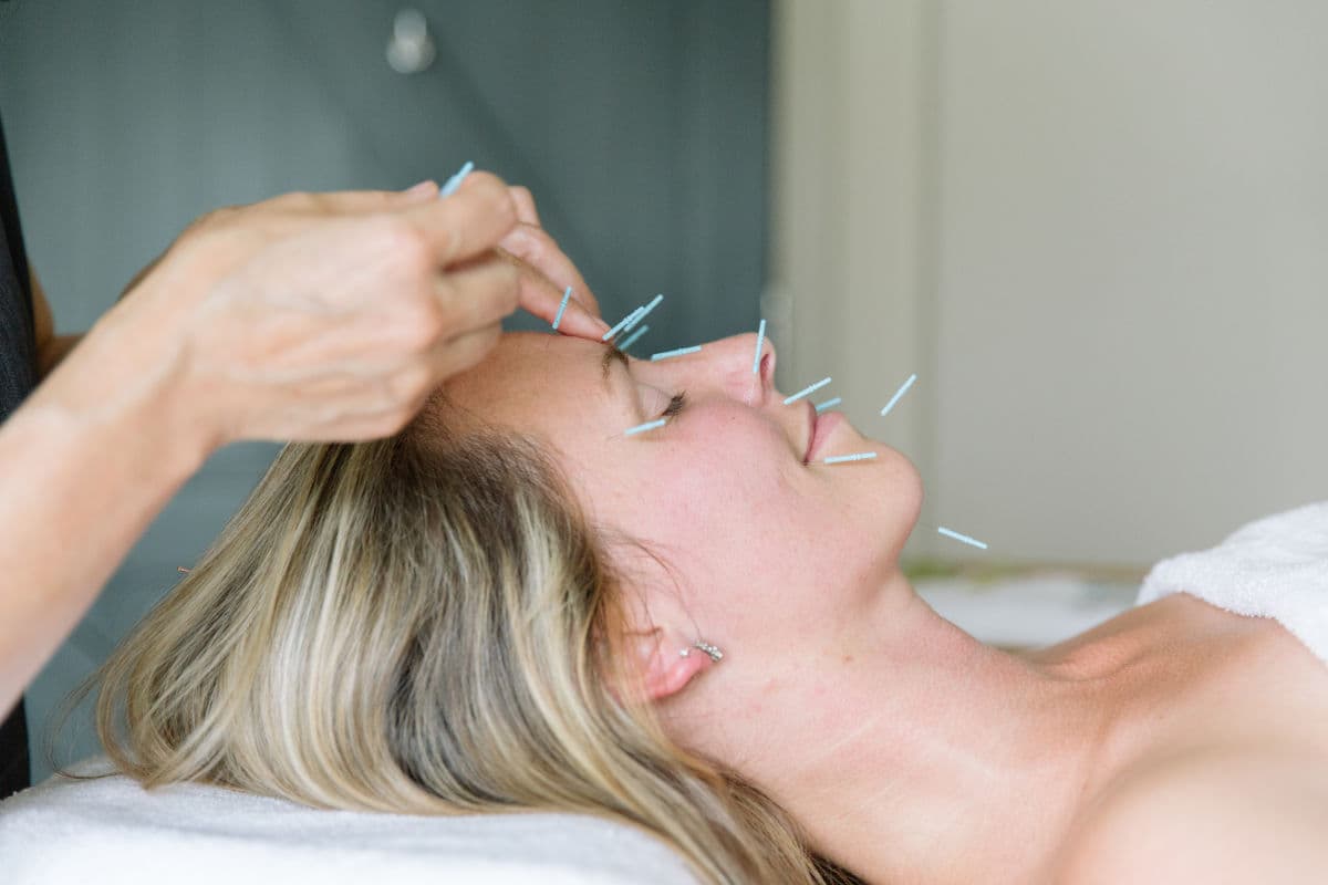 Facial acupuncture